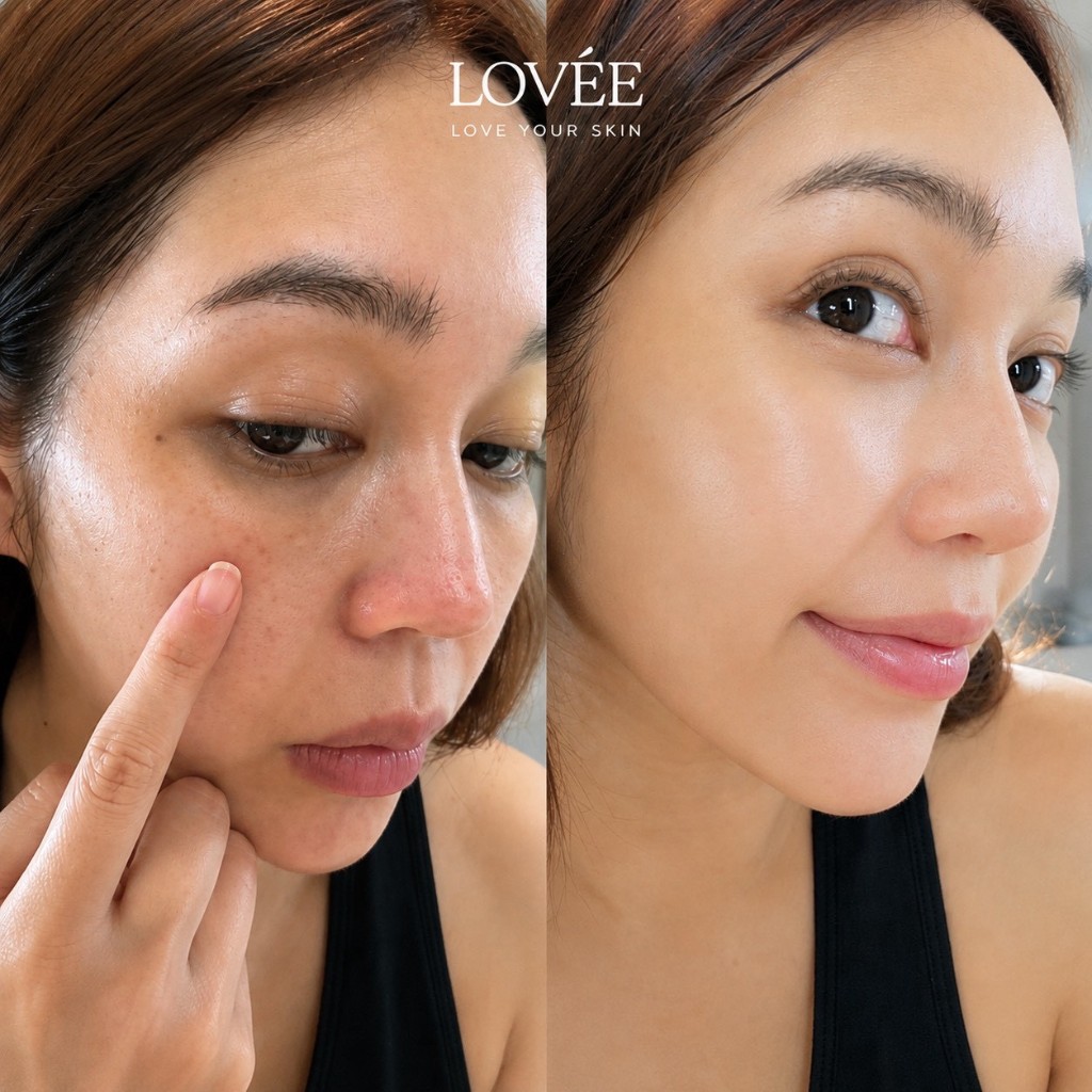 LOVÉE Before After รีวิวผลลัพธ์ 1