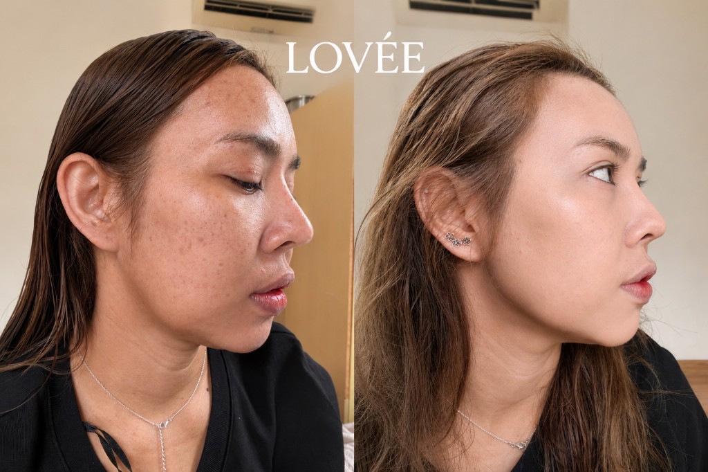 LOVÉE Before After รีวิวผลลัพธ์ 3